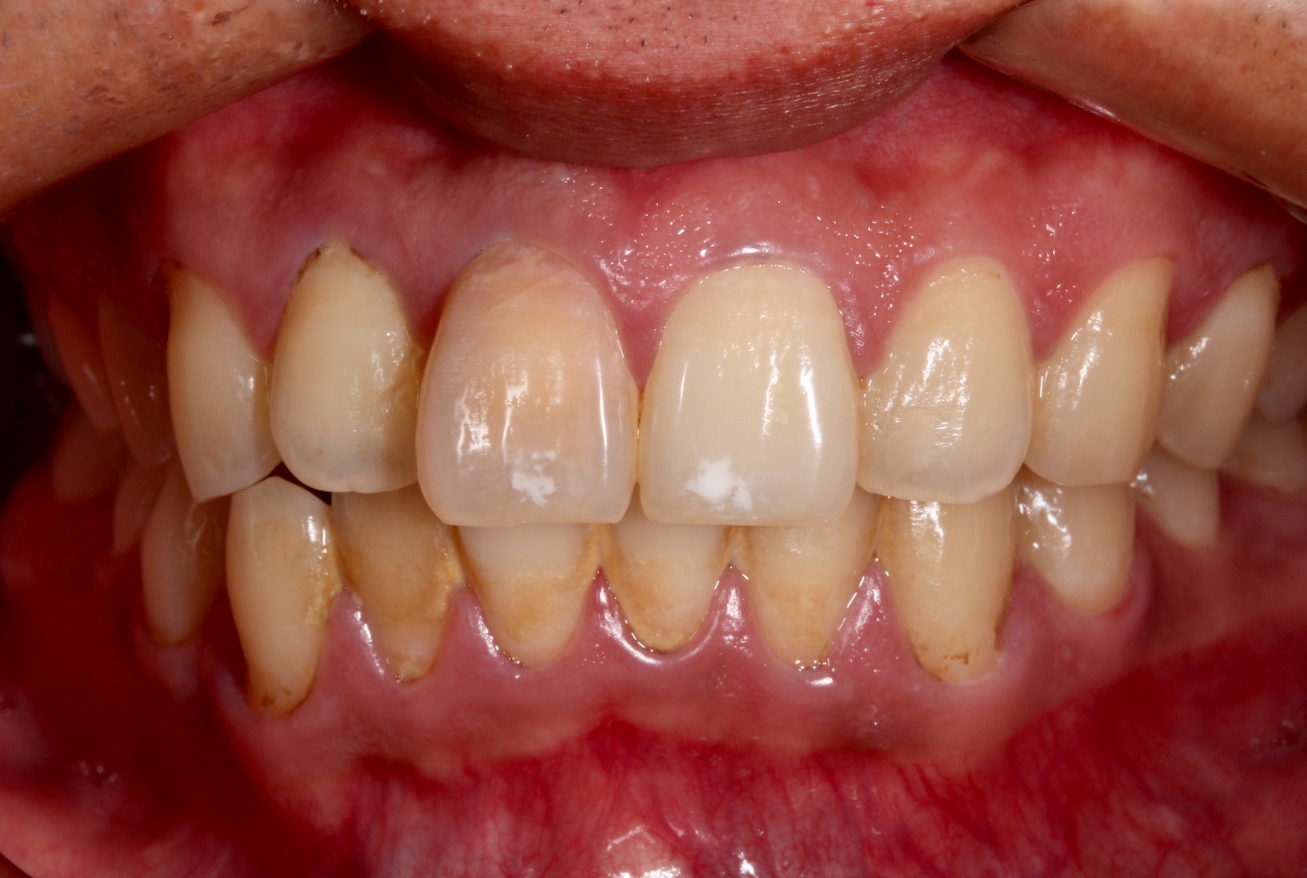 歯の色が気になる 歯の着色 変色について 新着情報