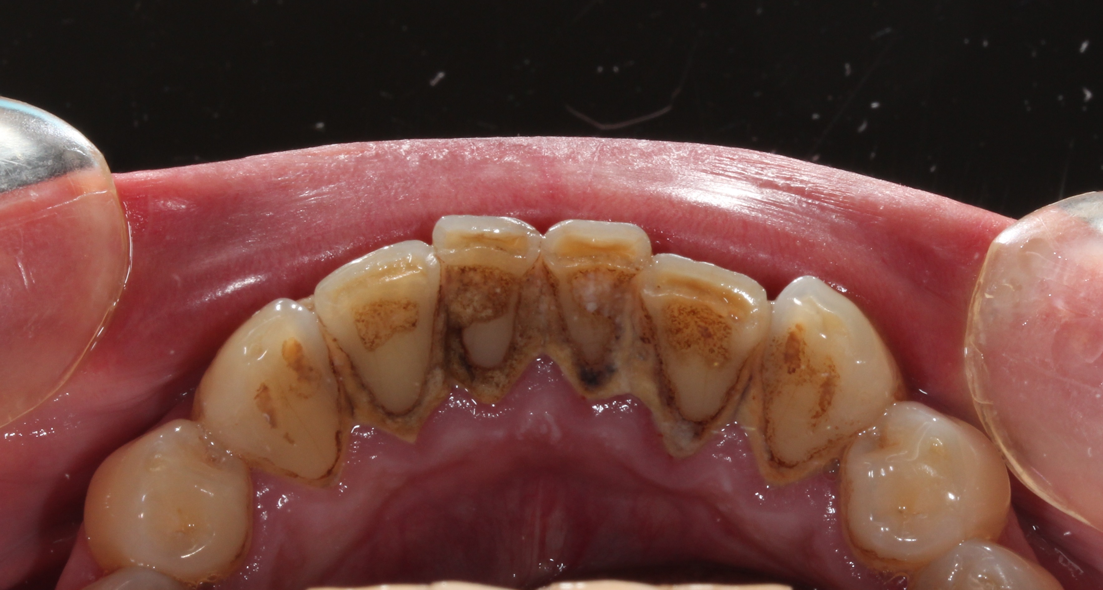 歯がザラザラする 歯石について 新着情報