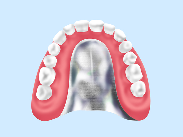 金属床義歯