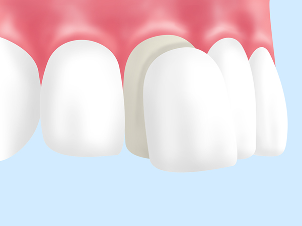 歯の見た目を手軽に改善する「ラミネートベニア」