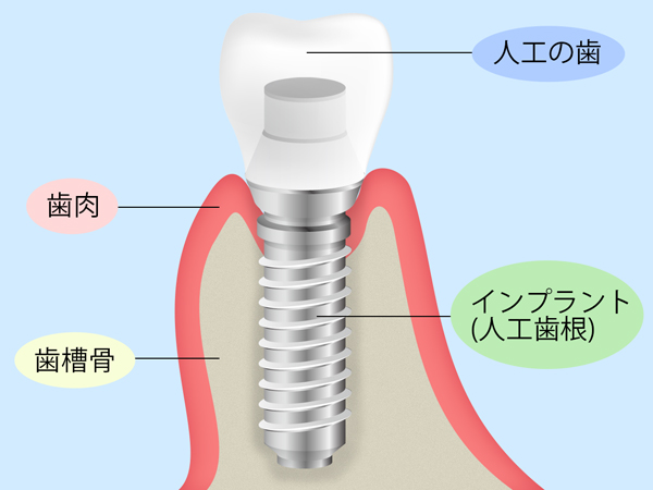 インプラント治療の流れ