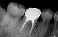 歯根破折と診断