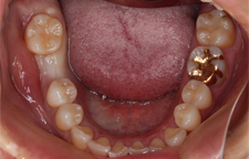 抜歯後2か月後の口腔内