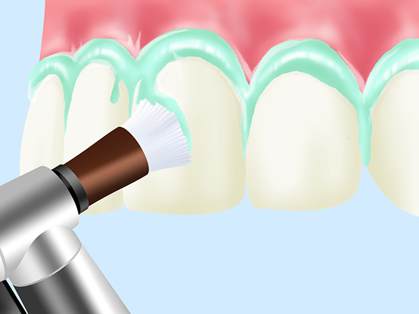 PMTC （Professional Mechanical Tooth Cleaning）